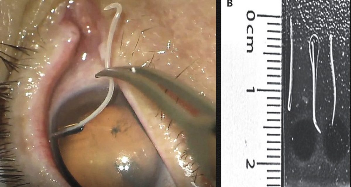 Врачи удалили из глаз 71-летнего корейца 11 живых червей